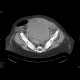 Incarcerated hernia, hematoma of abdominal wall: CT - Computed tomography